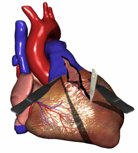 Cardiac Surgery Simulation - Illustrative Heart