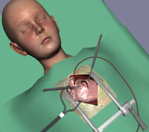 Cardiac Surgical Simulation - Open Thorax